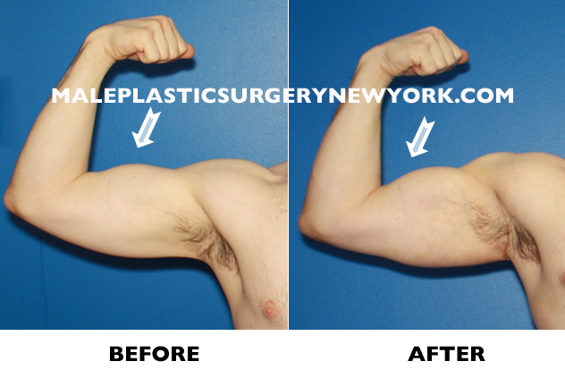 biceps-implants-before-after-NYC