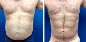 6-pack-implants-before-after