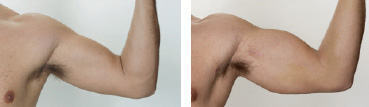 bicep-implants-before-after